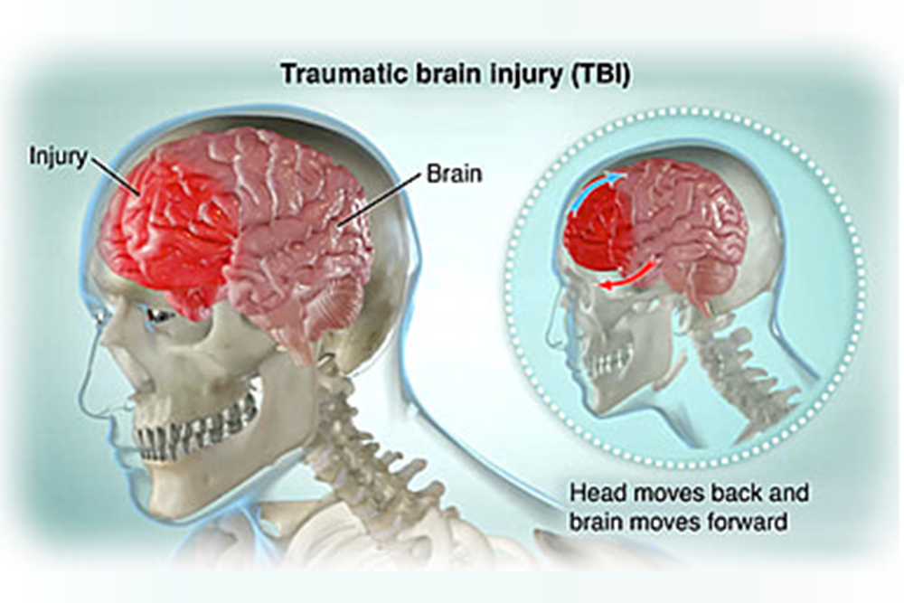 Какие последствия сотрясения мозга. Закрытая травма головы. Сотрясение головного мозга.